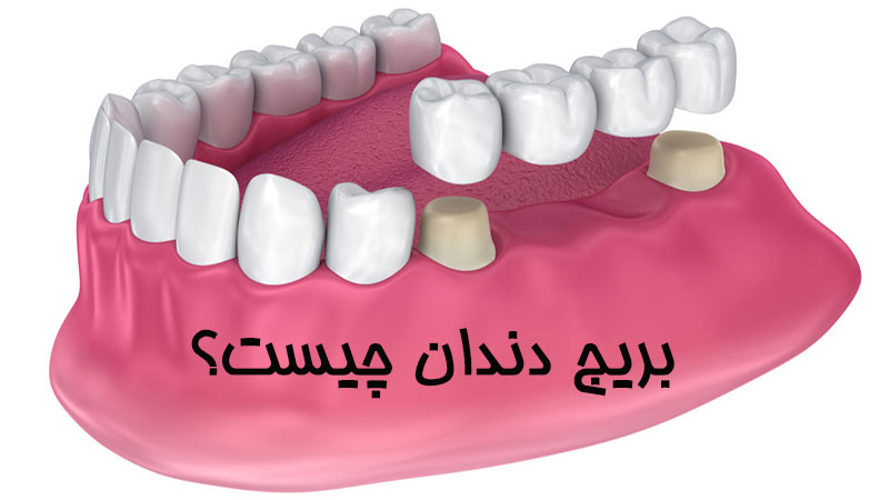 بریج دندان چیست؟