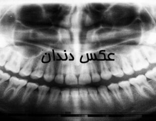 عکس دندان