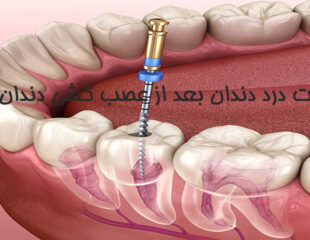 علت درد دندان بعد از عصب کشی دندان