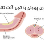 بیماری پیرونی یا کجی آلت تناسلی