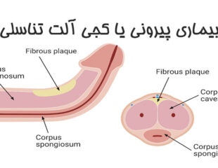 بیماری پیرونی یا کجی آلت تناسلی