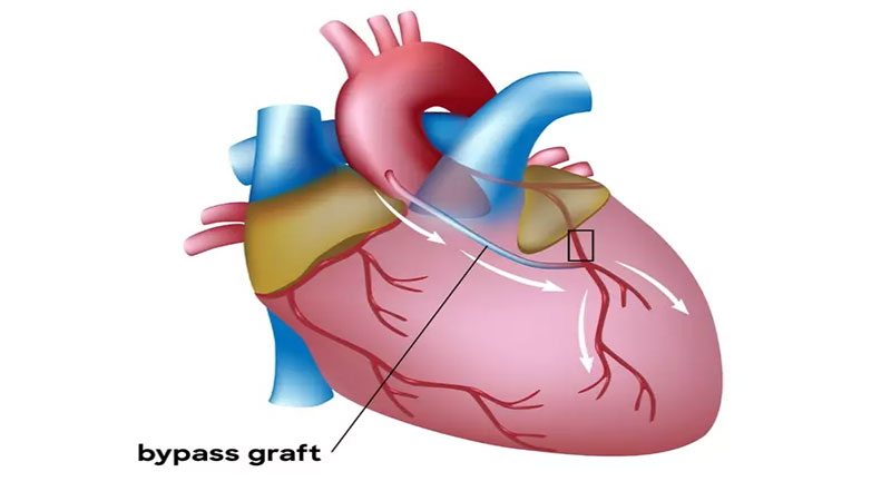 جراحی بای پس عروق کرونری