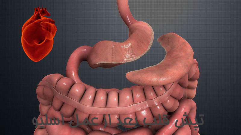 تپش قلب بعد از عمل اسلیو
