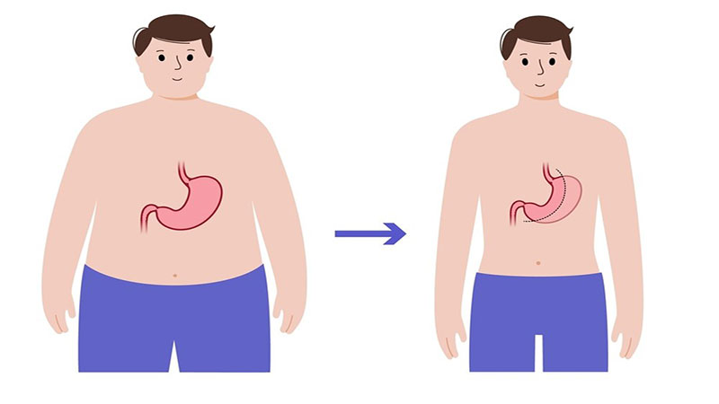 عمل اسلیو معده و تغییرات فیزیکی در بدن