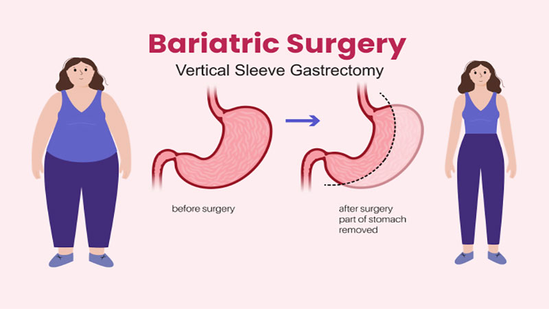 جراحی چاقی چیست؟