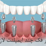 برای هر فک چند ایمپلنت لازم است