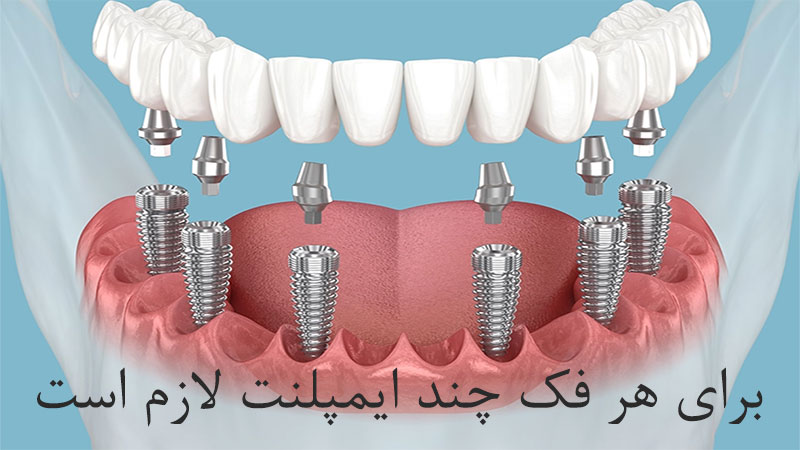 برای هر فک چند ایمپلنت لازم است