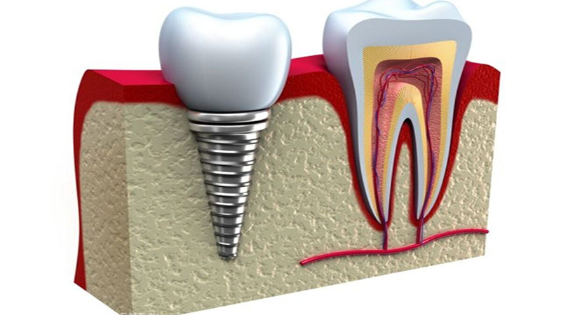 ایمپلنت دندان چیست؟