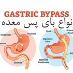 انواع بای پس معده
