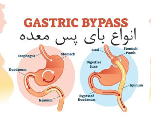 انواع بای پس معده