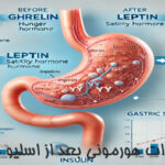 تغییرات هورمونی بعد از اسلیو معده