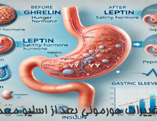 تغییرات هورمونی بعد از اسلیو معده