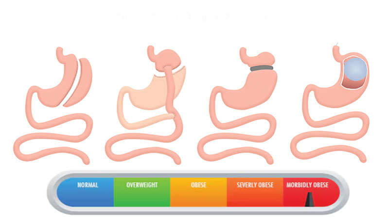 انواع جراحی های لاغری و bmi مورد تایید برای انجام عمل